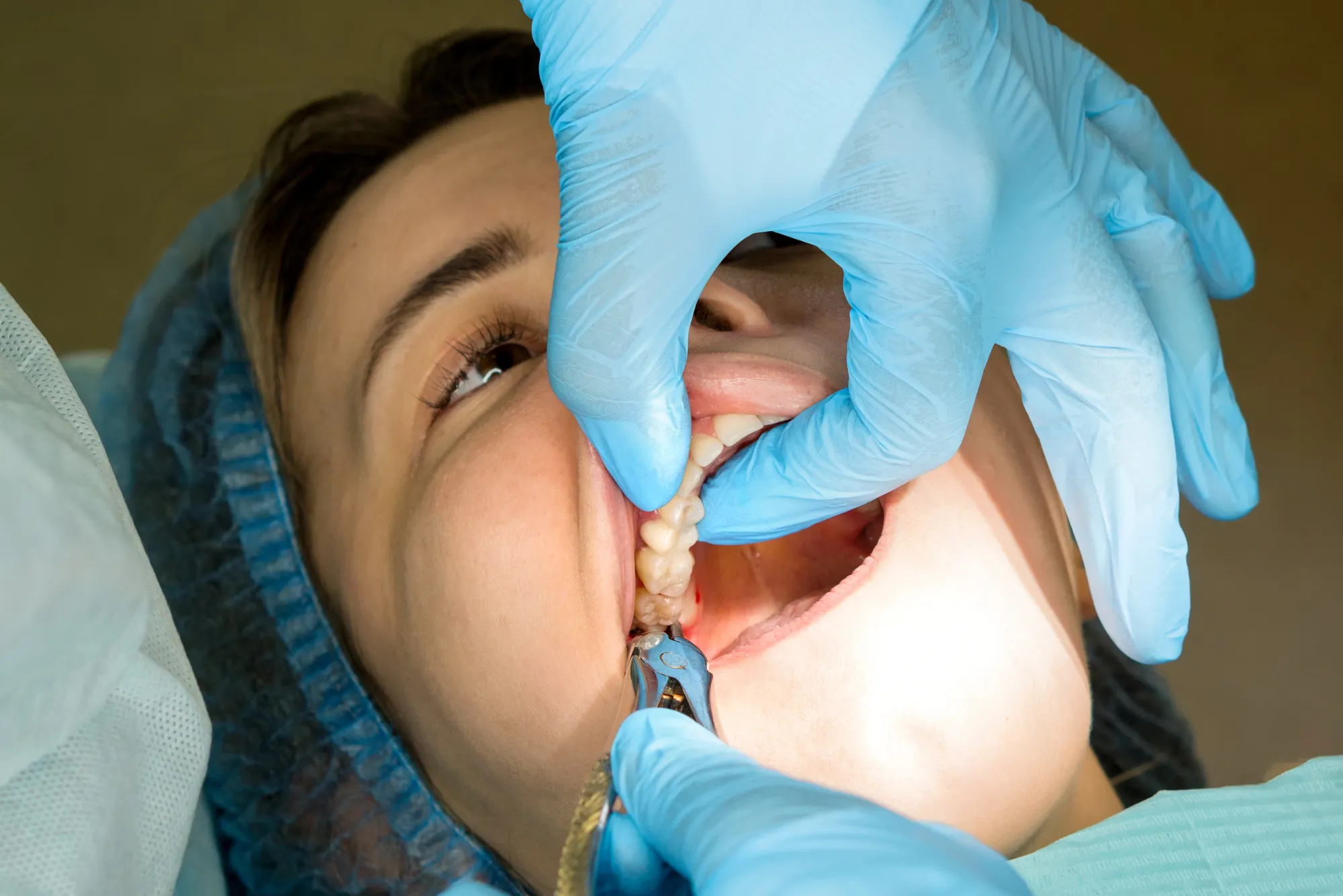 Wisdom Teeth Removal in Dubai